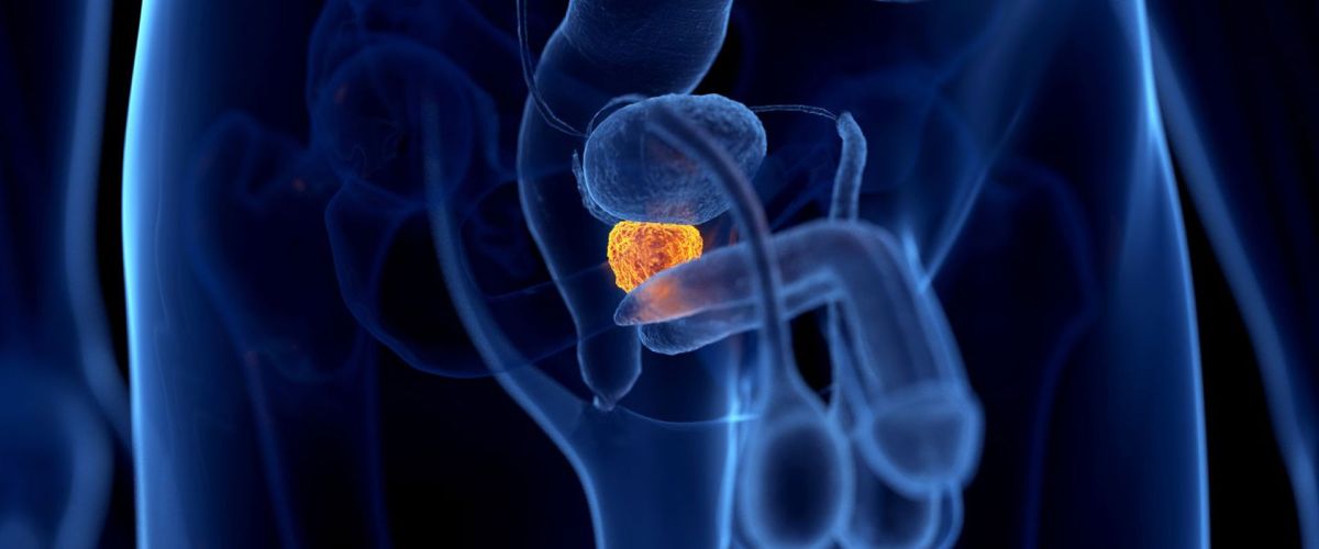 Prostatabeschwerden – Muss es soweit kommen?